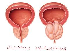 مصرف قارچ خطر ابتلا به سرطان پروستات را کم می‌کند