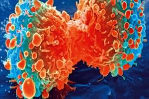 شایع‌ترین سن ابتلا به سرطان در ایران