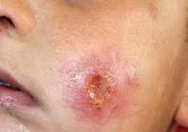 کاهش 6درصدی بیماری سالک در مشهد