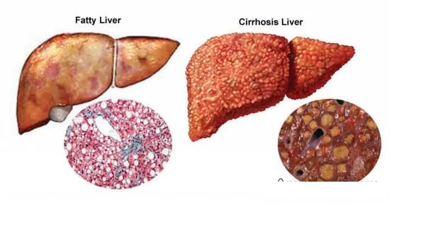 علائم و روش‌های درمان کبد چرب گرید ۲