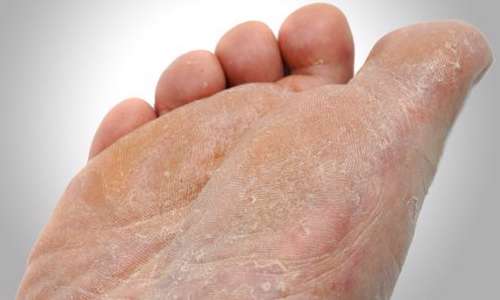 ۸ روش برای از بین بردن پوست مرده کف پا