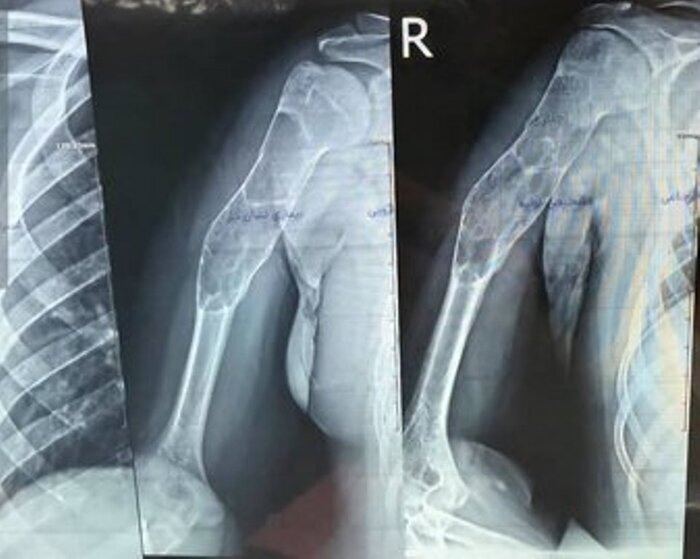پیوند موفقیتآمیز استخوان مصنوعی بازو در پارسآباد پیوند موفقیتآمیز استخوان مصنوعی بازو در پارسآباد